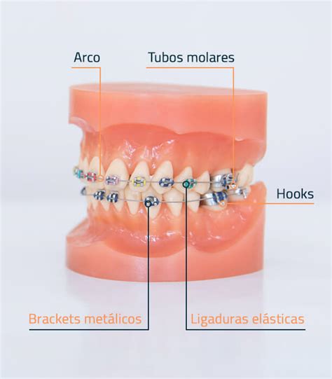 partes de un bracket metalico|Partes de la ortodoncia con brackets .